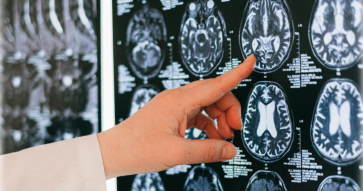 szifilisz, kankó nemi betegségek